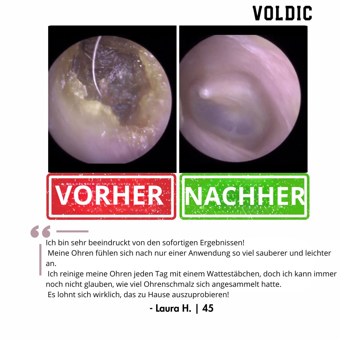 Voldic – Elektrisches Ohrreinigungs‑Set